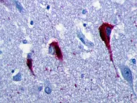 Degenerazioni neurofibrillari dovute alla proteina tau nell'ippocampo di un malato di Alzheimer