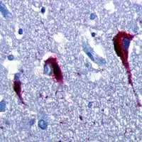 Degenerazioni neurofibrillari dovute alla proteina tau nell'ippocampo di un malato di Alzheimer