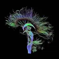 Ricostruzione trattografica delle connessioni neurali