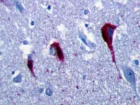 Degenerazioni neurofibrillari dovute alla proteina tau nell'ippocampo di un malato di Alzheimer