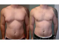 Ginecomastia nella sindrome di Klinefelter