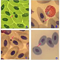 Fotografie al microscopio ottico di anomalie del nucleo e di micronuclei