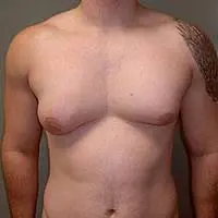 Ginecomastia nella sindrome di Klinefelter