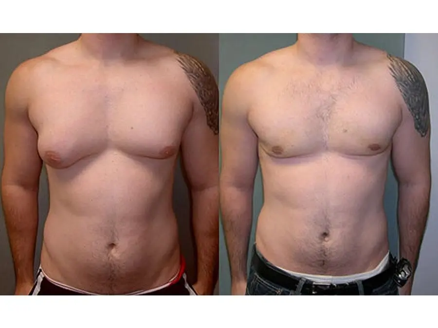 Ginecomastia nella sindrome di Klinefelter