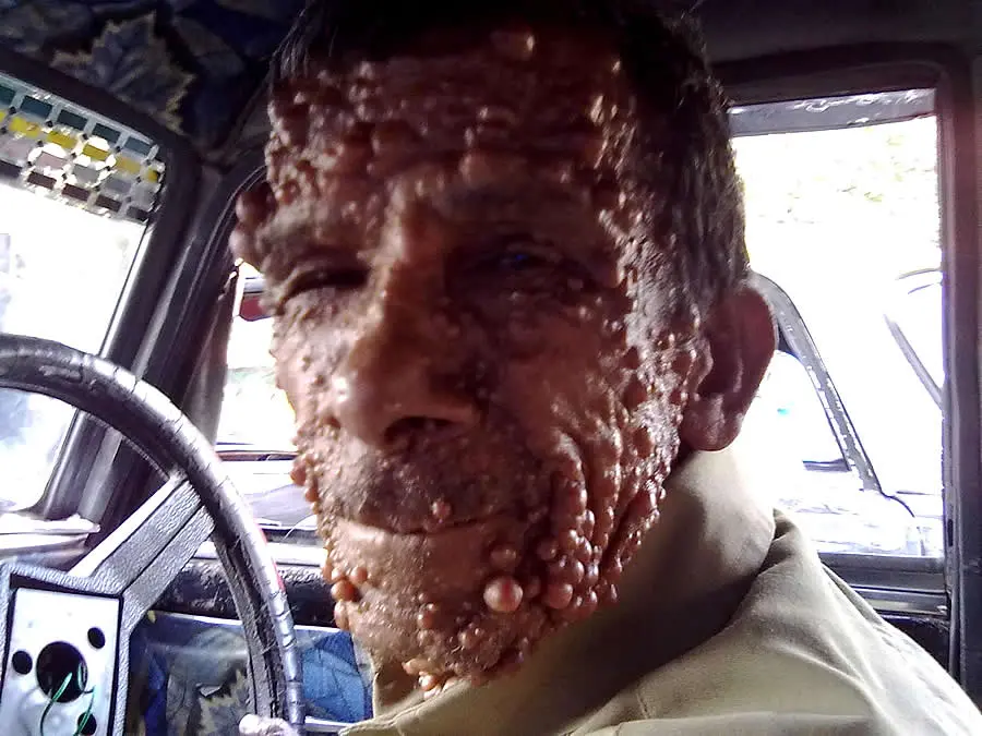 Fotografia del viso di un uomo affetto da neurofibromatosi dermica con crescita di tumori benigni a carico della pelle